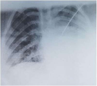 The Discrepancies of COVID-19 Clinical Spectrum Between Infancy and Adolescence – Two Case Reports and a Review of the Literature